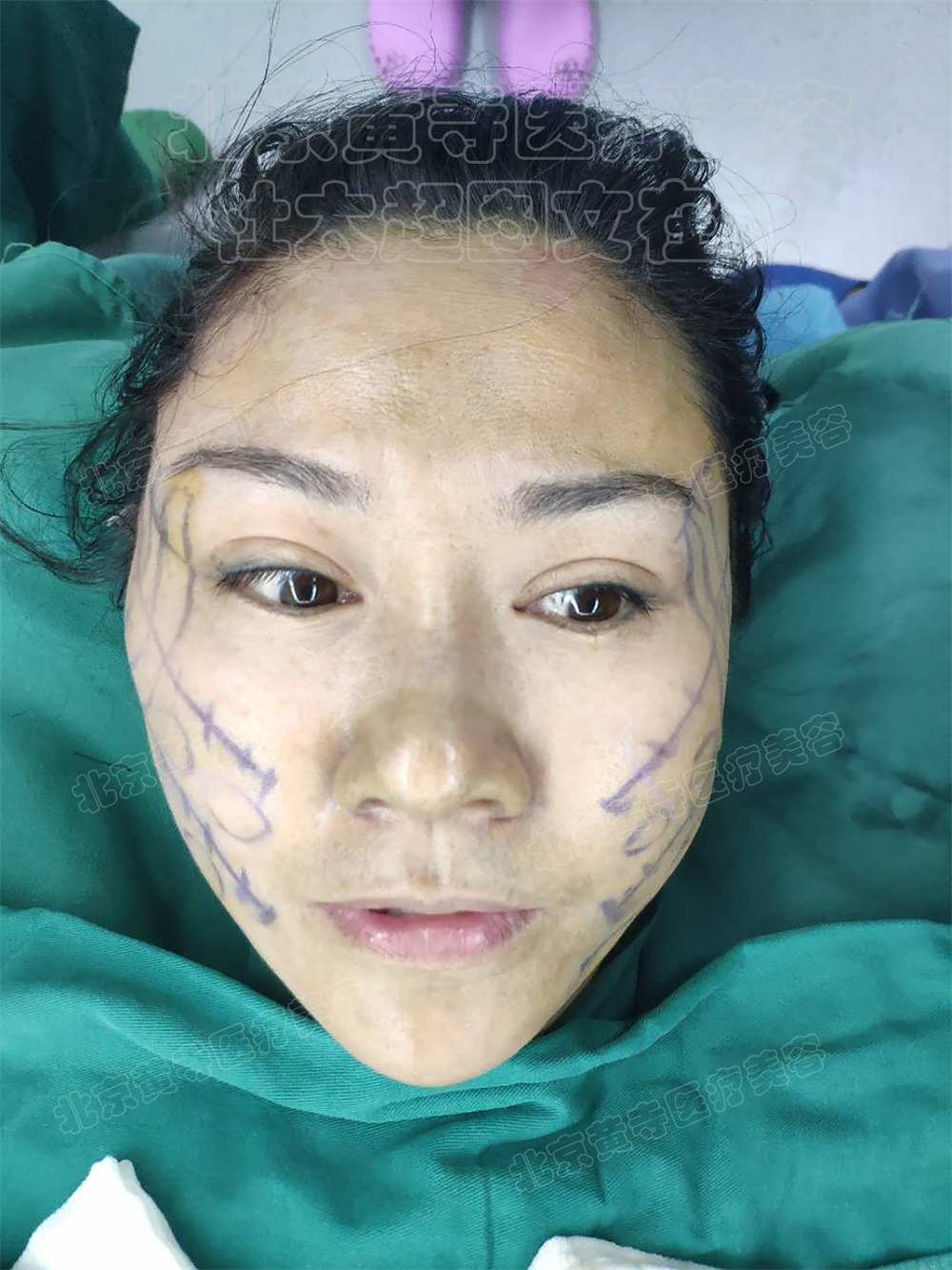 单侧拉皮即刻对比