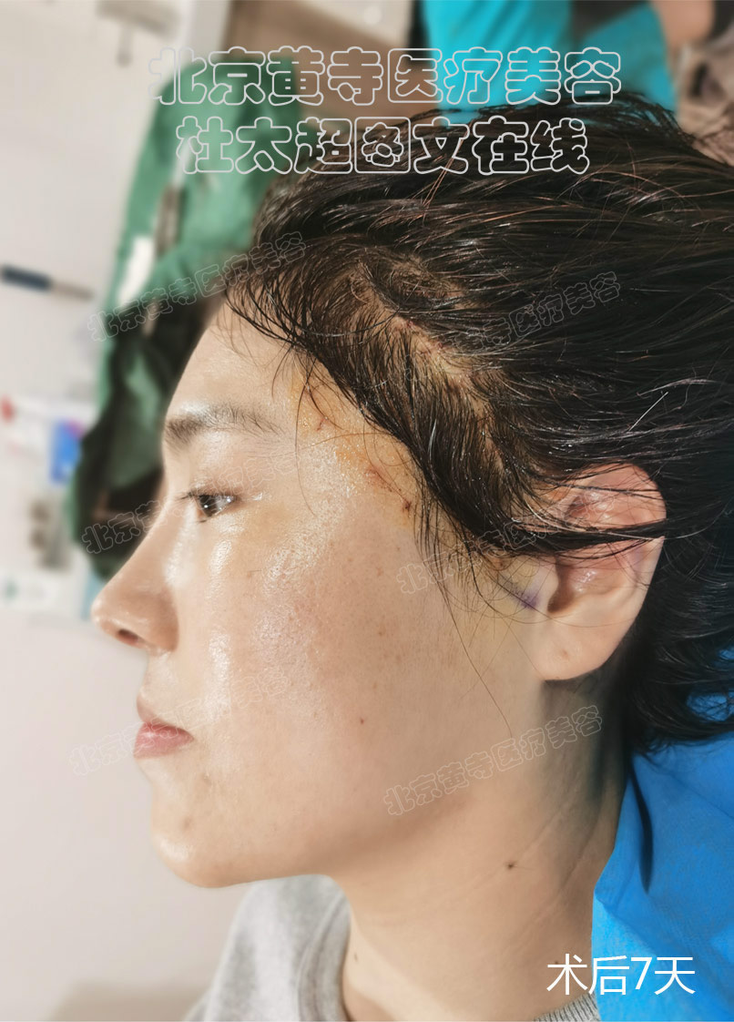 头发部术后恢复过程7天-36个月