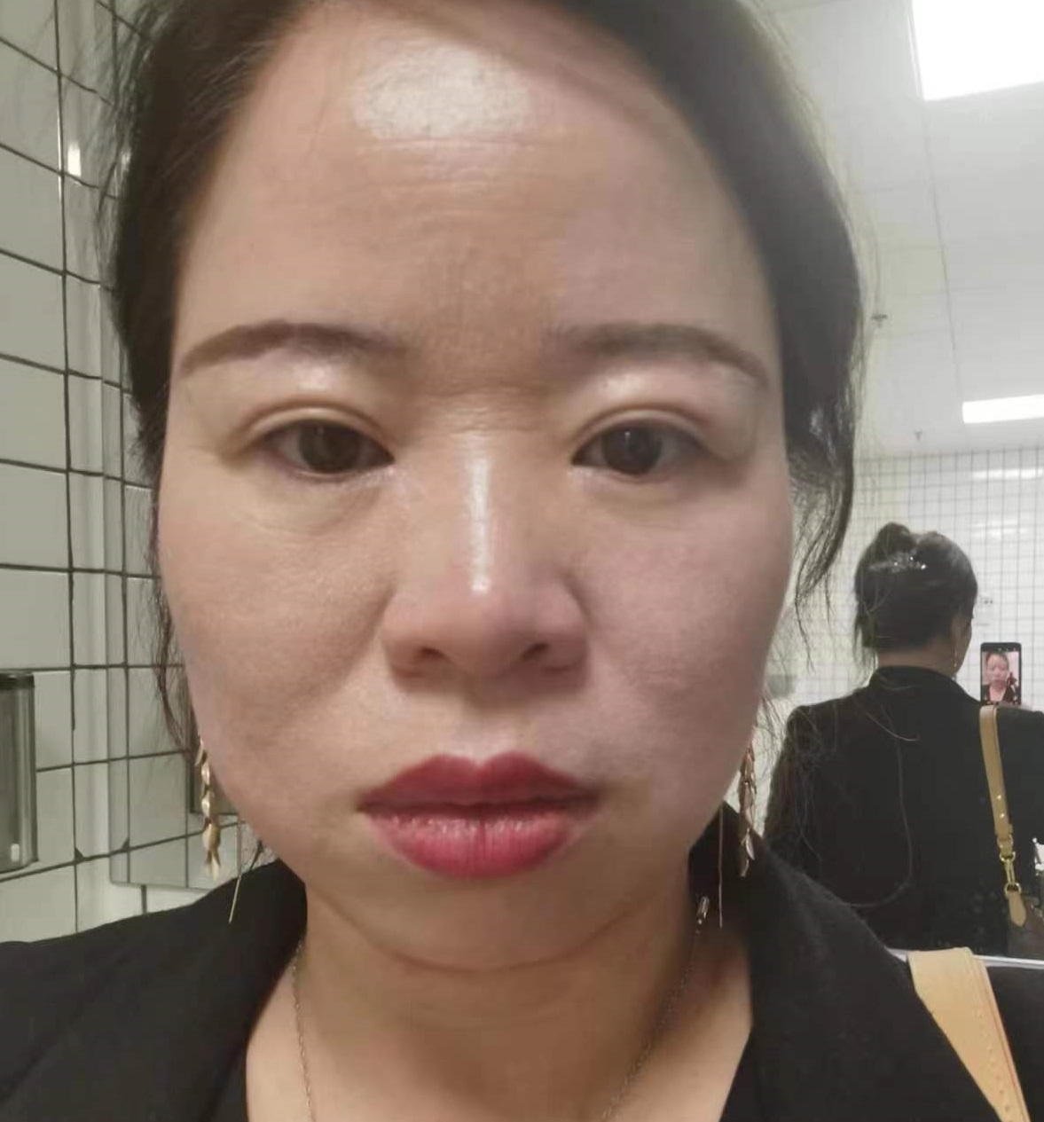 45岁求美者做完拉皮手术，闺蜜说年轻了20岁，后悔做晚了