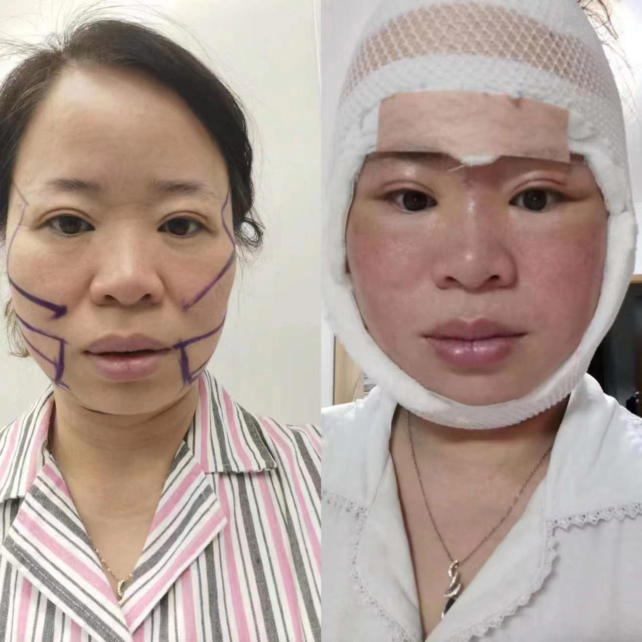 45岁求美者做完拉皮手术，闺蜜说年轻了20岁，后悔做晚了