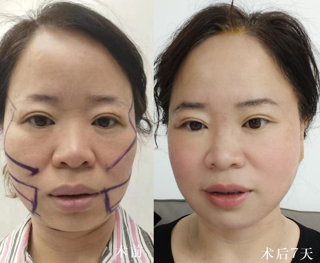 45岁求美者做完拉皮手术，闺蜜说年轻了20岁，后悔做晚了