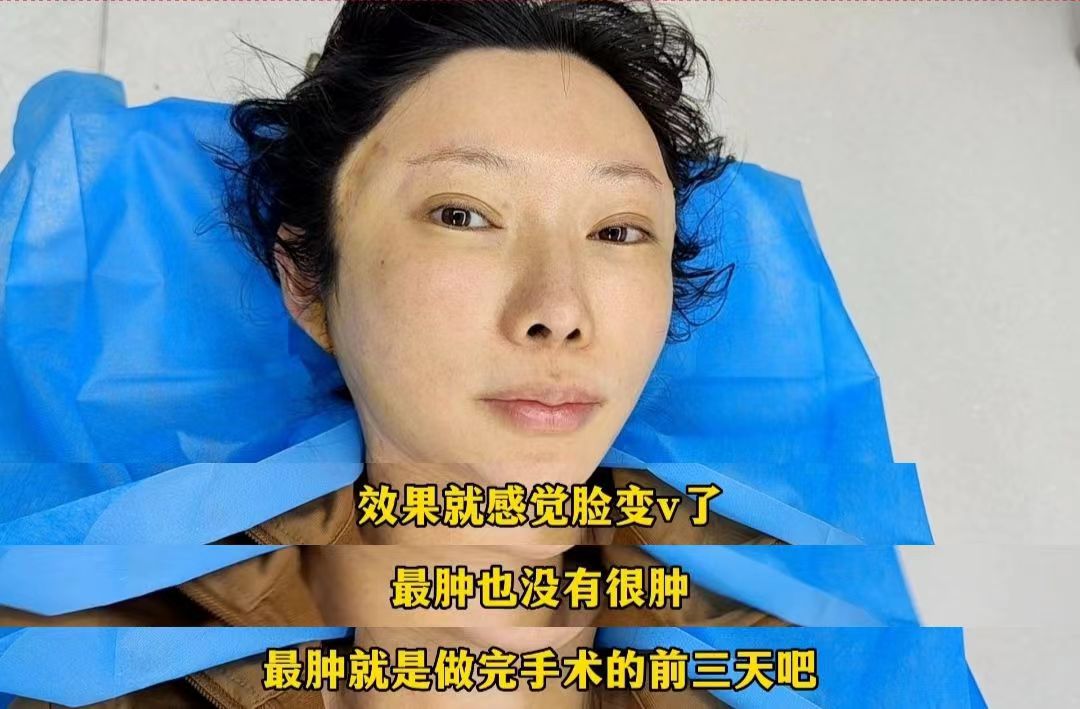 39岁求美者追求面部年轻感，公开术后效果