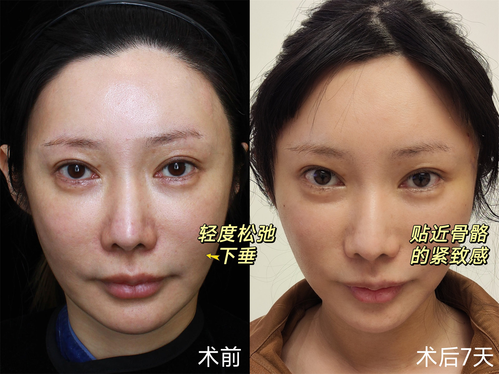 39岁求美者追求面部年轻感，公开术后效果