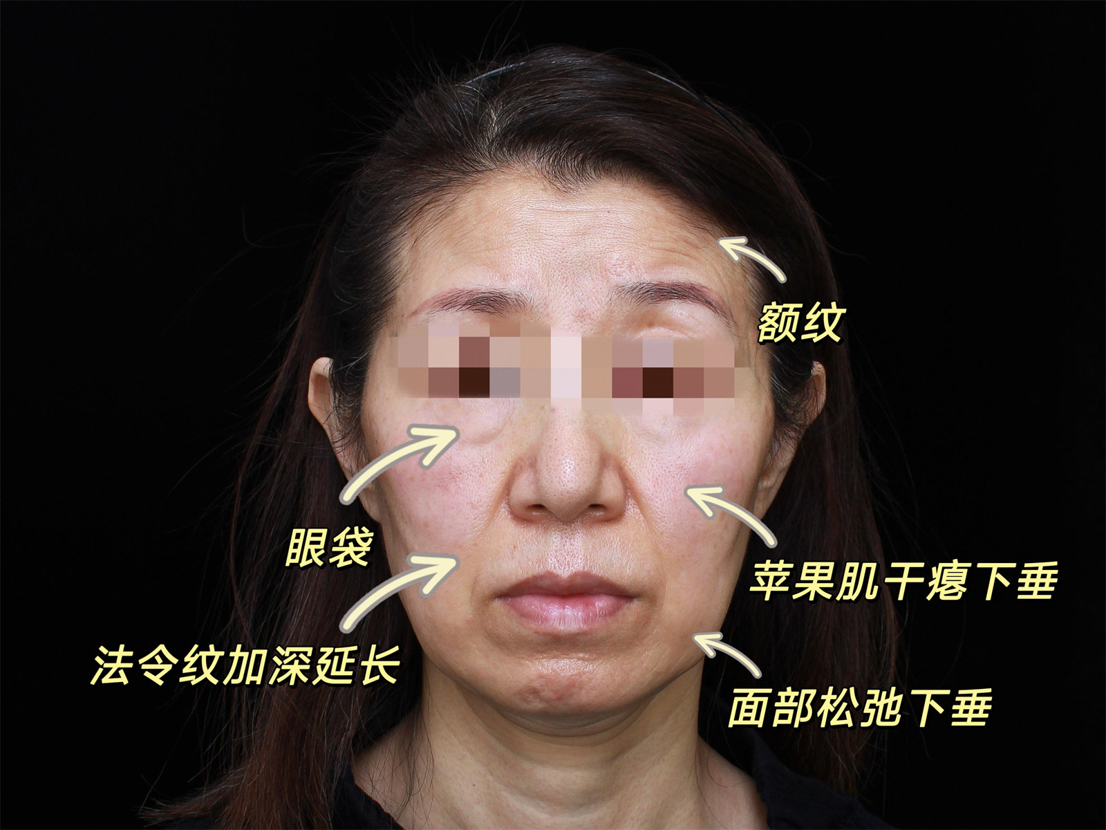 55岁独自来做拉皮，术后像变了一个人