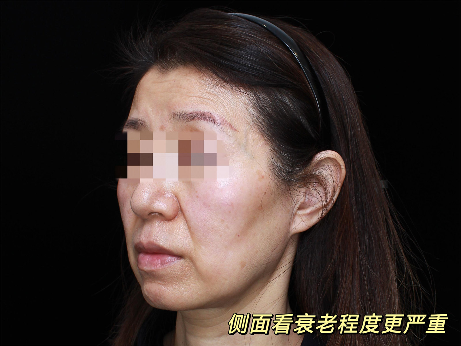 55岁独自来做拉皮，术后像变了一个人