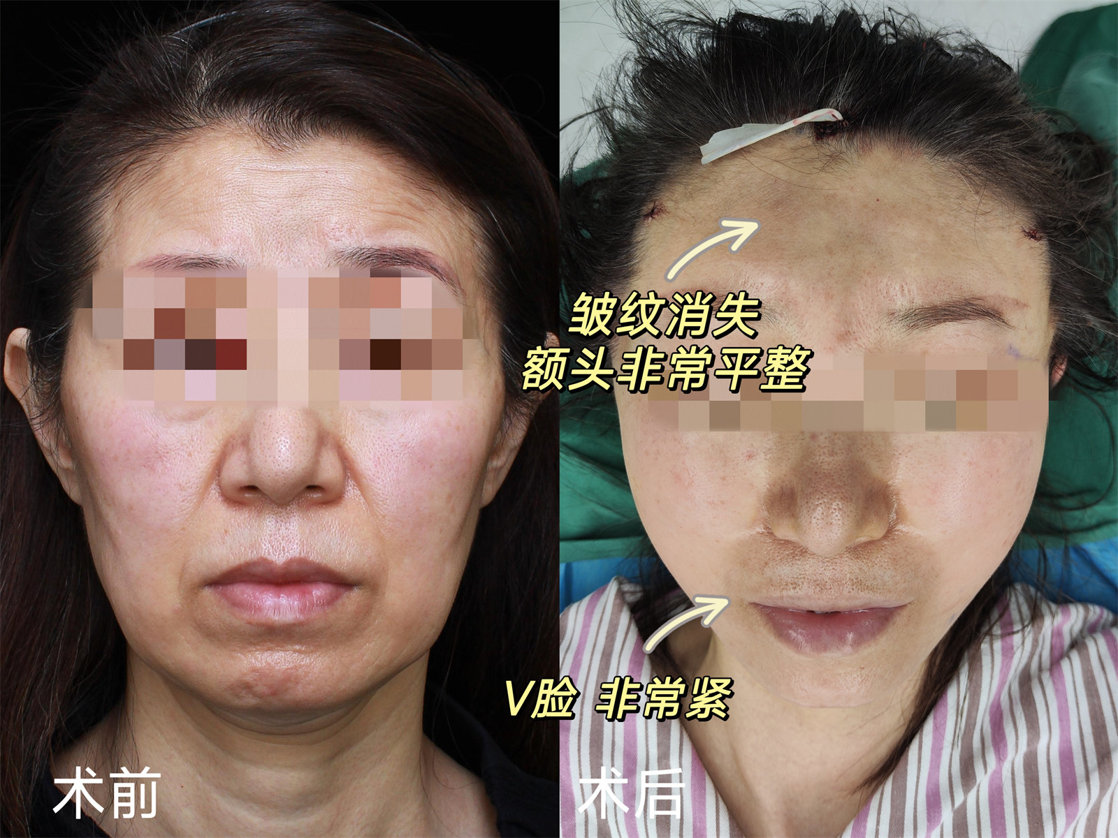 55岁独自来做拉皮，术后像变了一个人