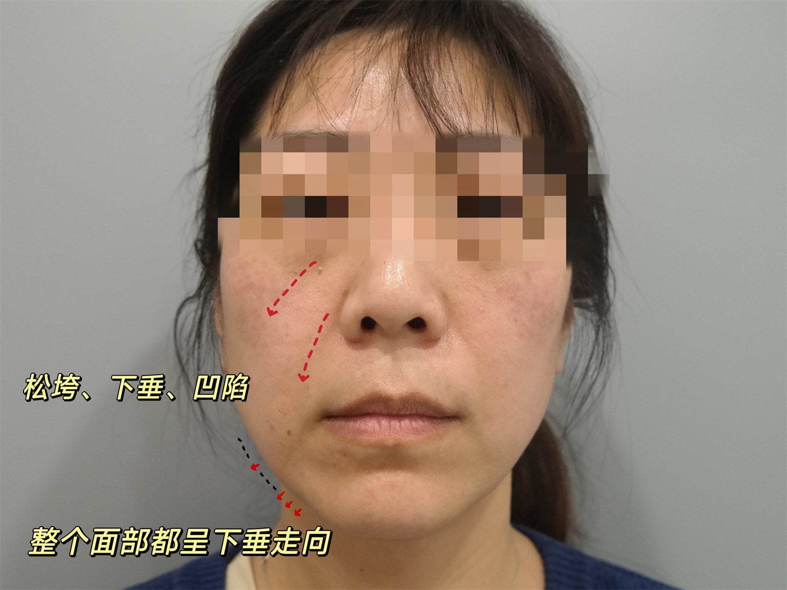 42岁求美者瞒着家人来做拉皮手术，刚2天说瞒不住了，只怪效果太好