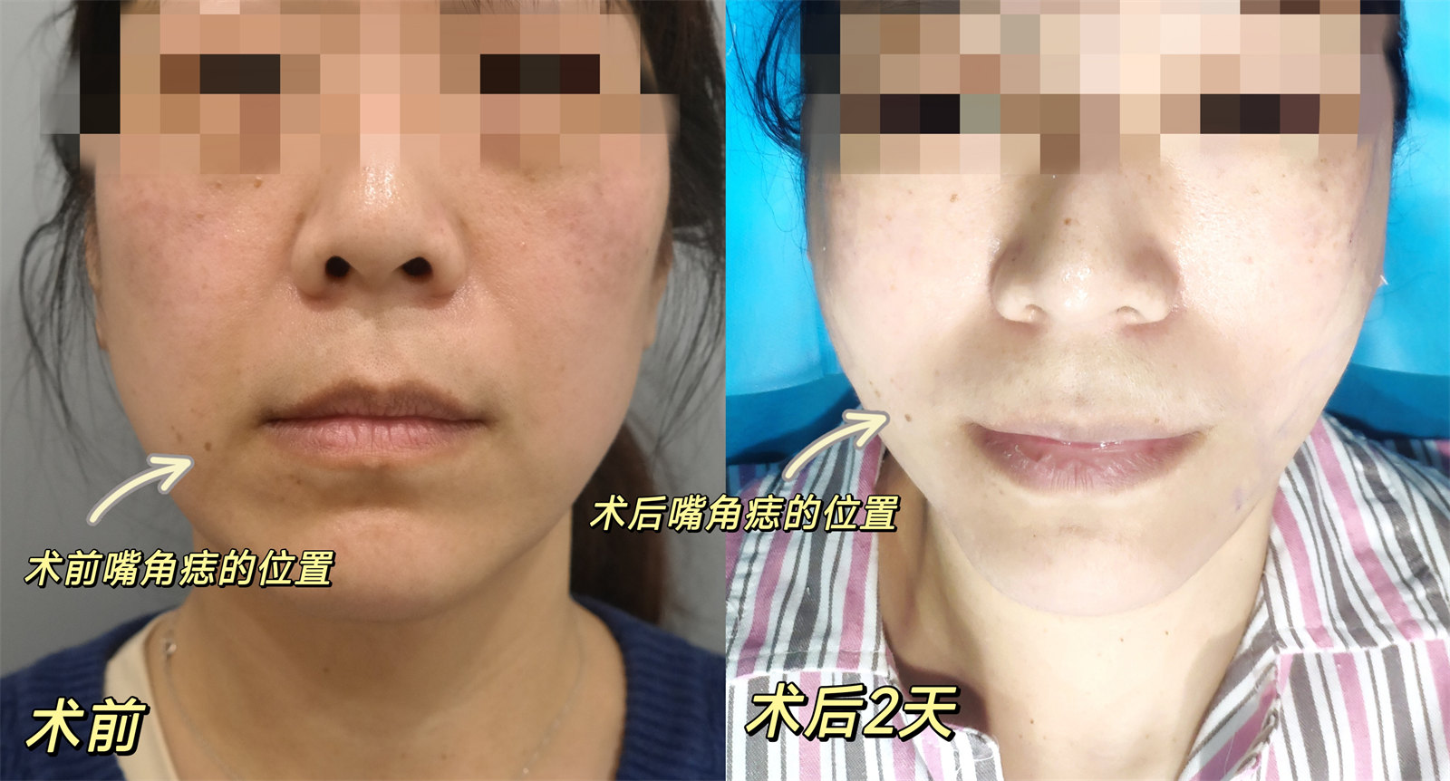 42岁求美者瞒着家人来做拉皮手术，刚2天说瞒不住了，只怪效果太好