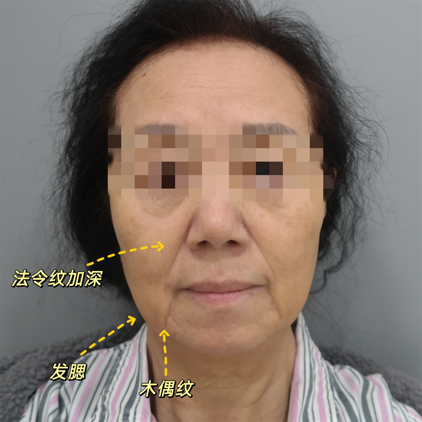 70岁不服老来北京做了拉皮,术后效果很惊艳,年轻了10多岁! 70岁不服老来北京做了拉皮,术后效果很惊艳,年轻了10多岁!