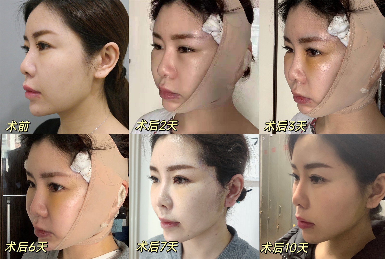 关于拉皮手术的恢复期、疼痛、肿胀、疤痕，看这一篇文章就够了！