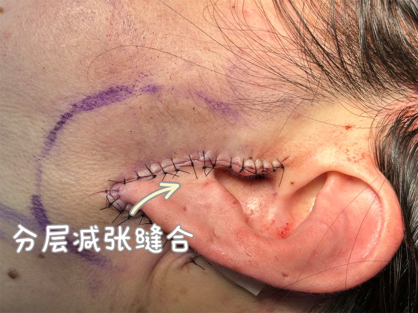 关于拉皮手术的恢复期、疼痛、肿胀、疤痕，看这一篇文章就够了！