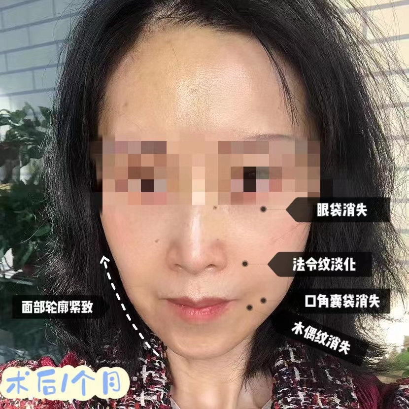 姐妹四人一起来做拉皮手术，术后1个月效果很惊艳！