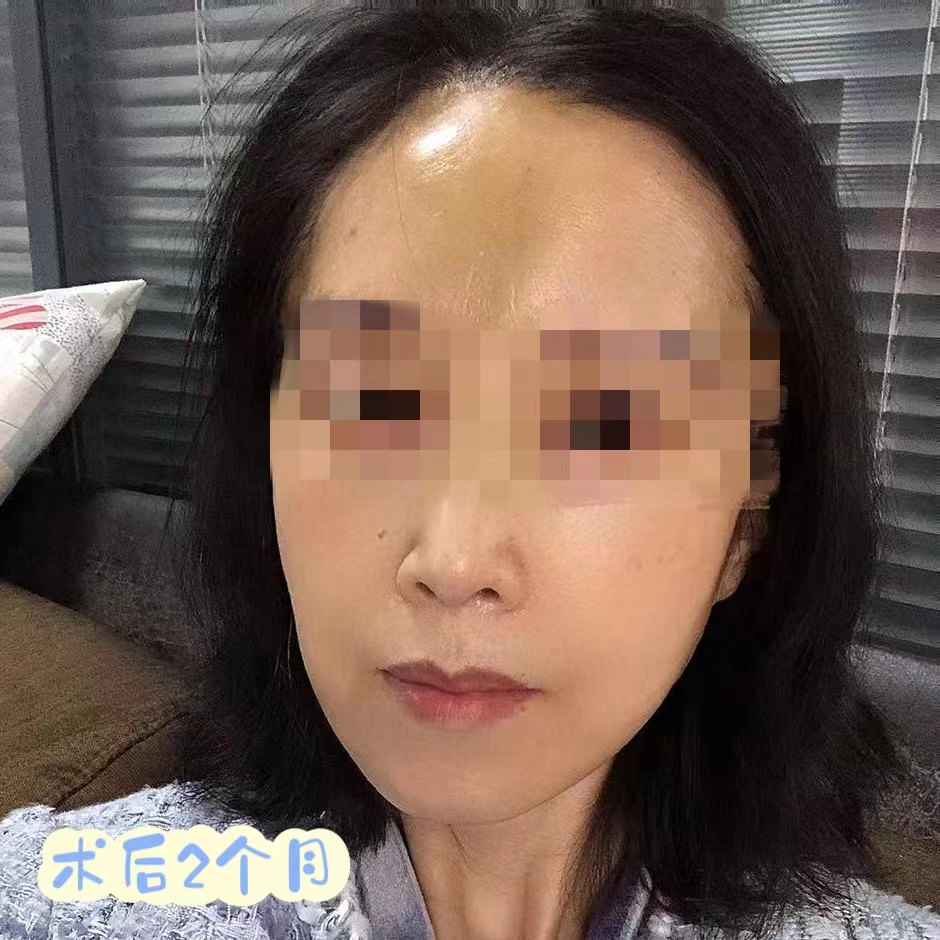 姐妹四人一起来做拉皮手术，术后1个月效果很惊艳！