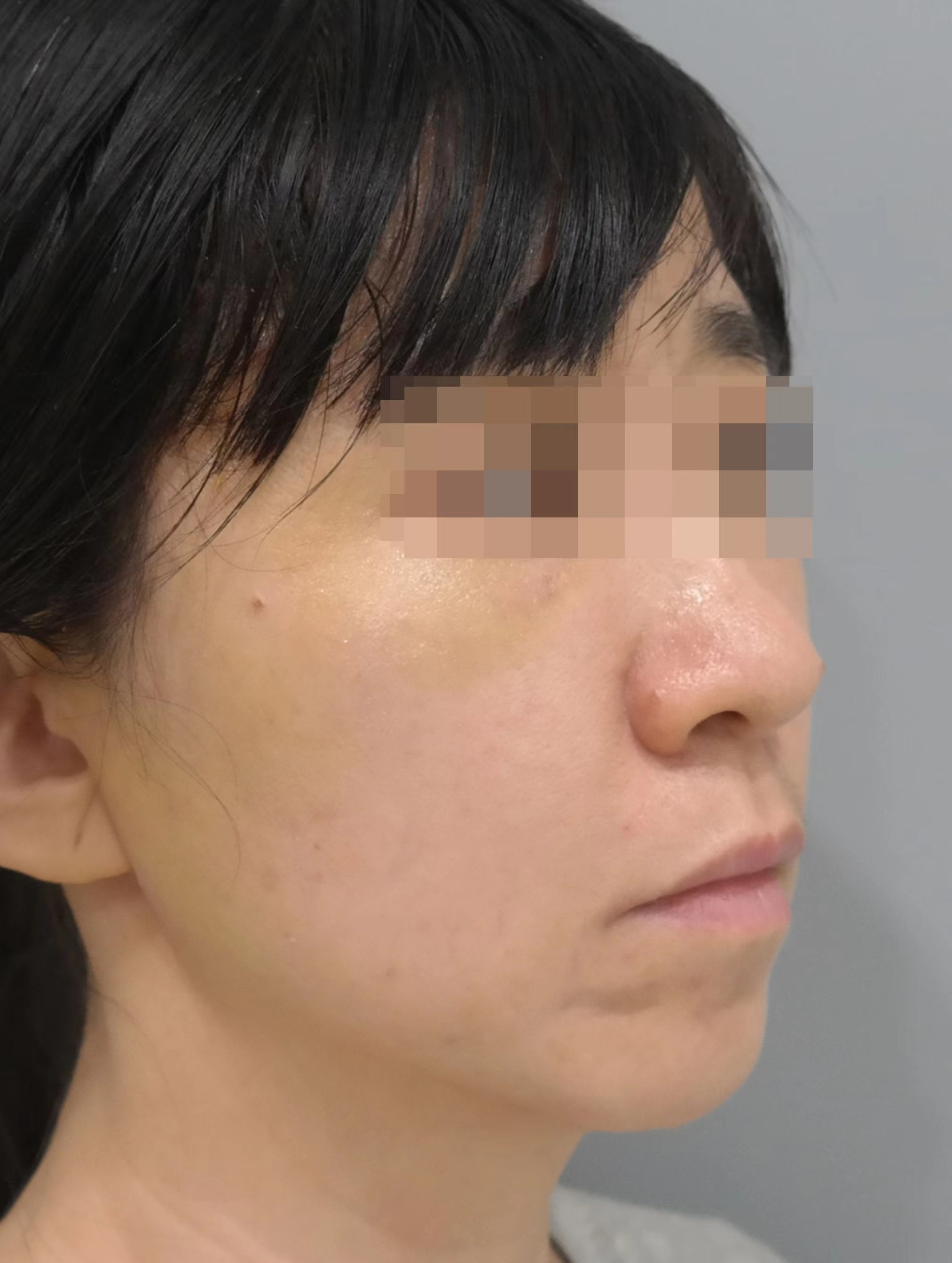 拉皮术后7天，没怎么变但又变化巨大？