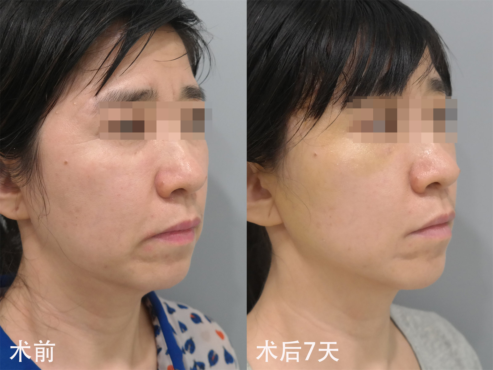 拉皮术后7天，没怎么变但又变化巨大？
