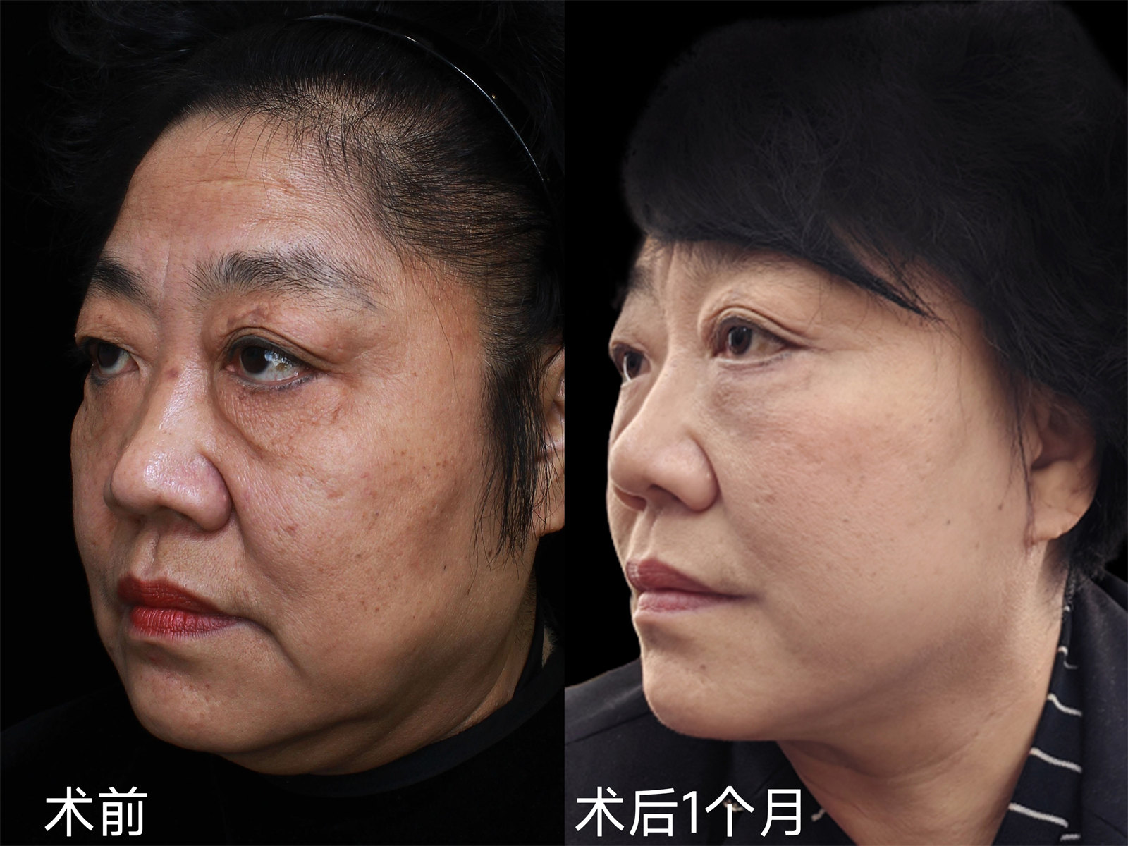 想了好几年，终于在60岁这年做了拉皮手术，说点心里话