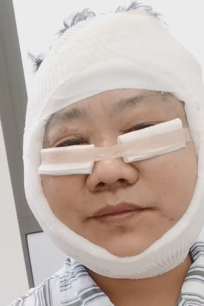 想了好几年，终于在60岁这年做了拉皮手术，说点心里话
