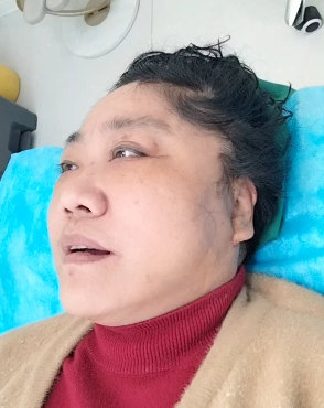 想了好几年，终于在60岁这年做了拉皮手术，说点心里话