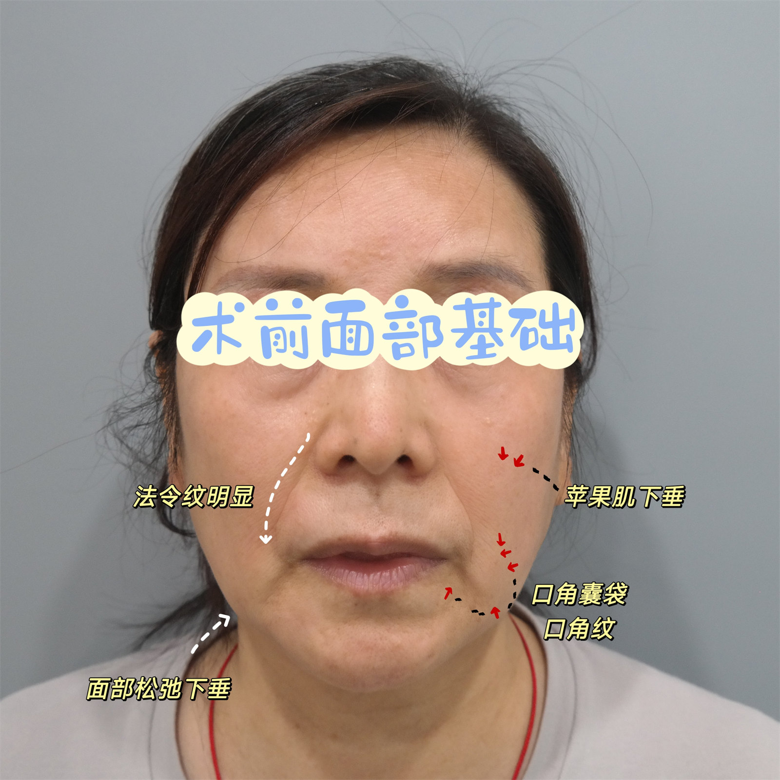 55岁做了拉皮手术，7天时间恢复成这样！3个不可思议