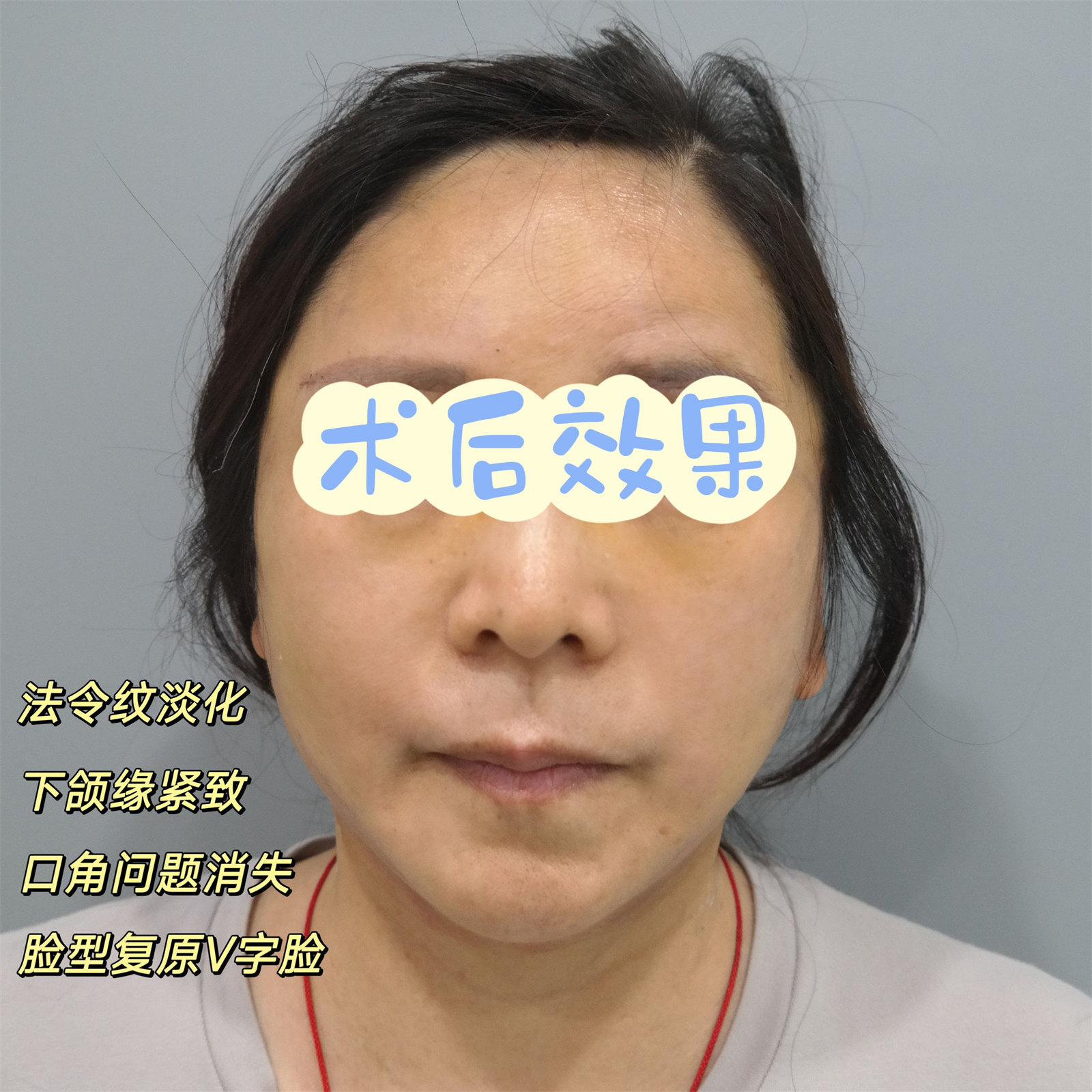 55岁做了拉皮手术，7天时间恢复成这样！3个不可思议