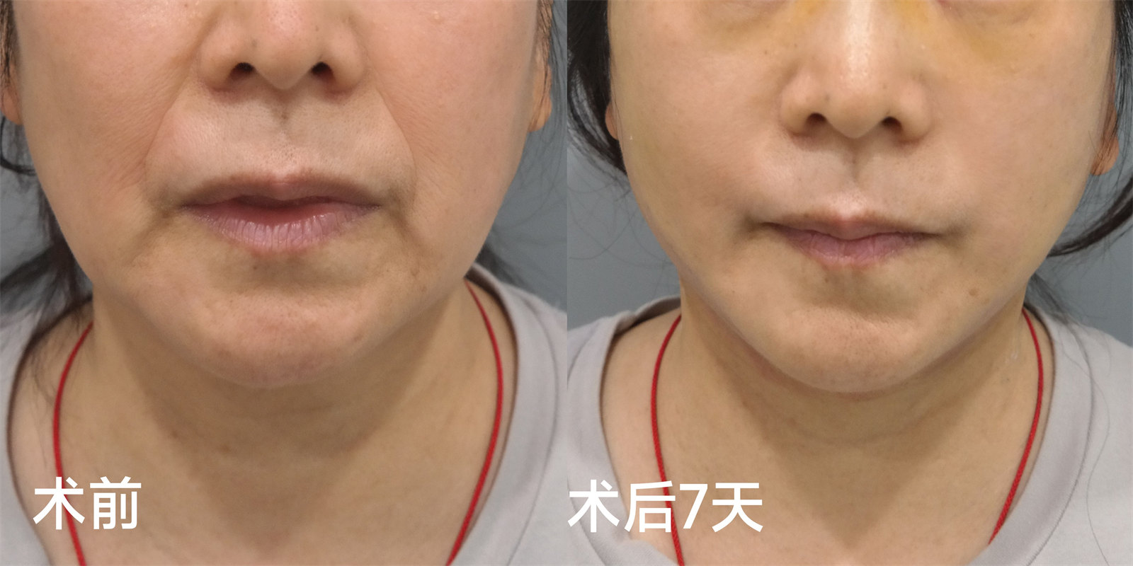 55岁做了拉皮手术，7天时间恢复成这样！3个不可思议