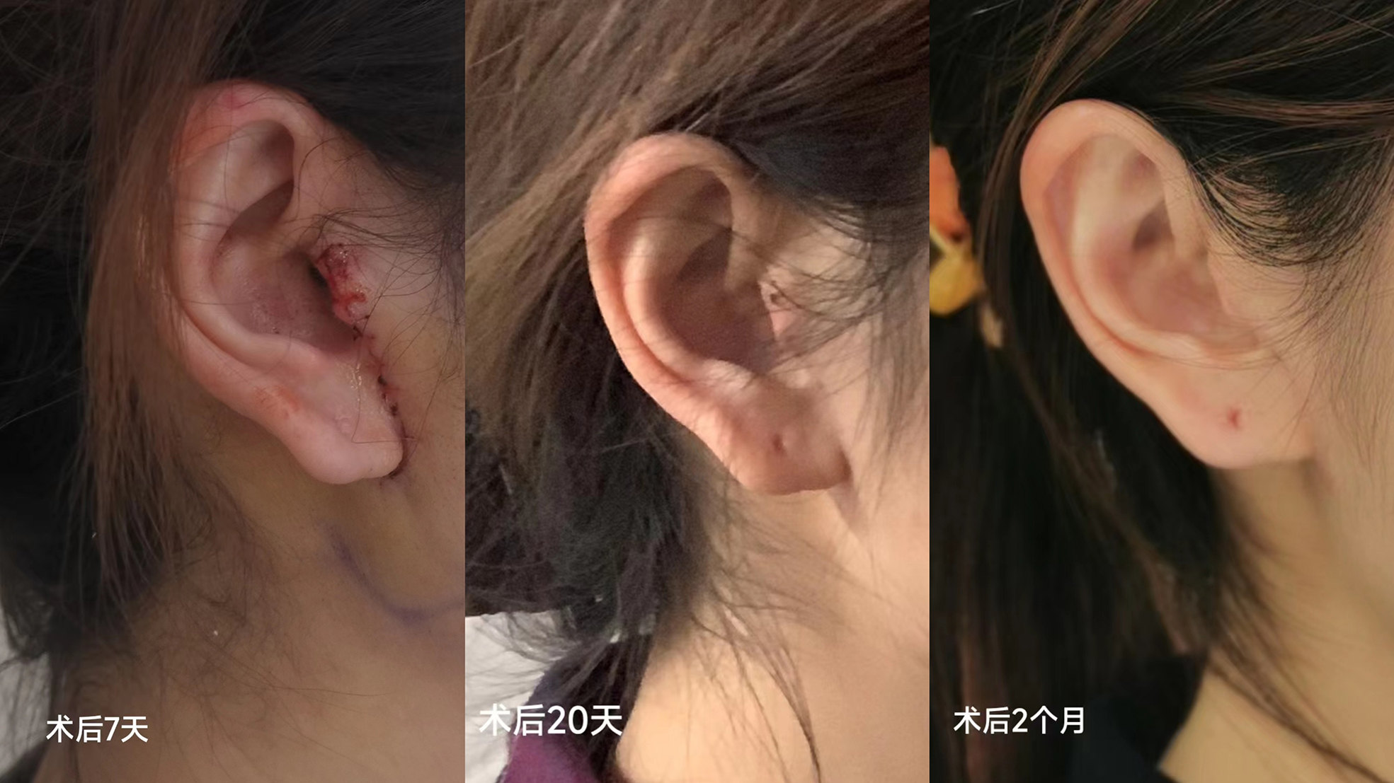 做拉皮手术怎么才能不留疤痕？