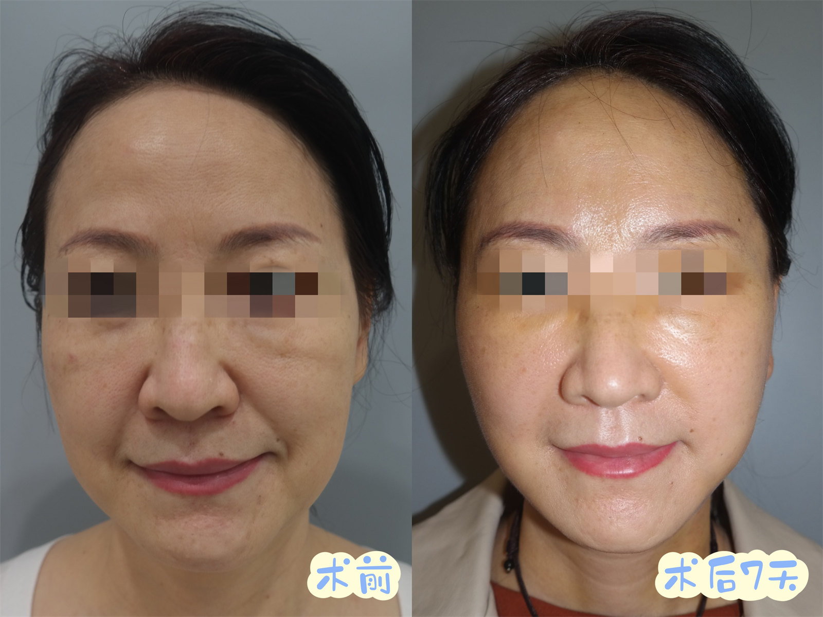 拉皮术后7天，法令纹消失了，非常满意！