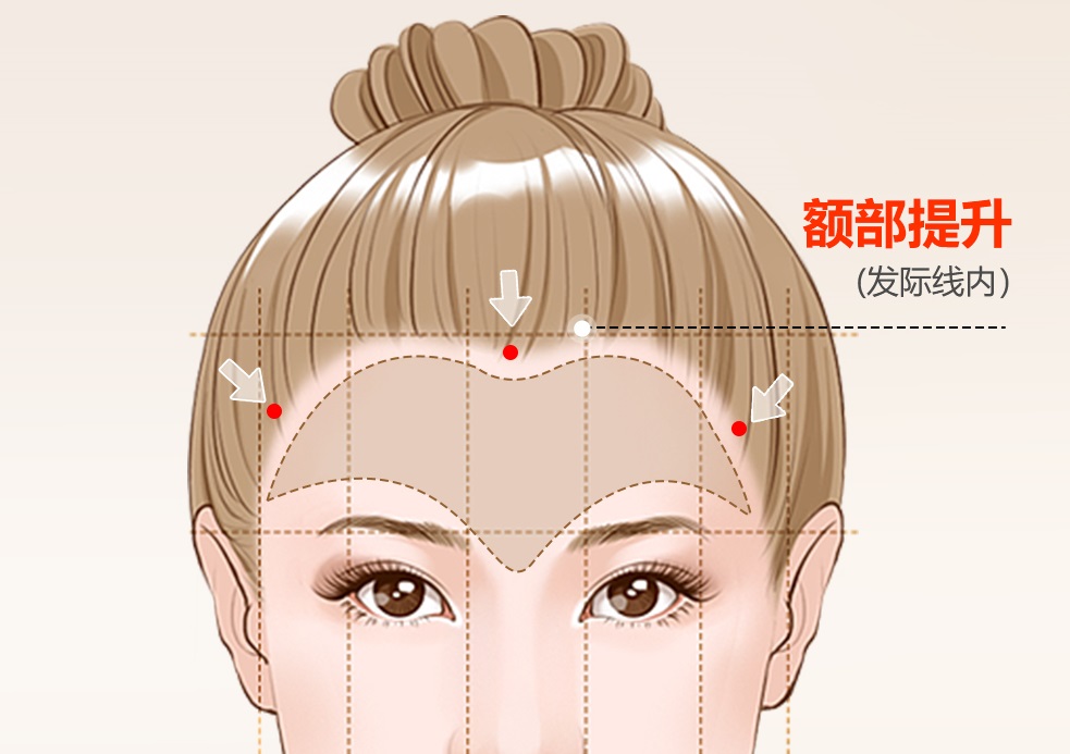 做拉皮手术需要住院吗？