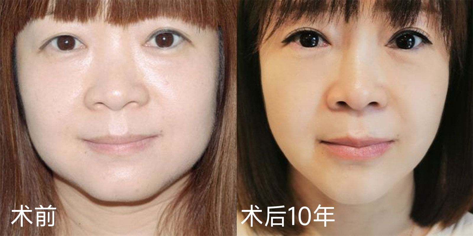 解决面部松弛、脂肪堆积、发腮问题！线雕拉皮怎么选？