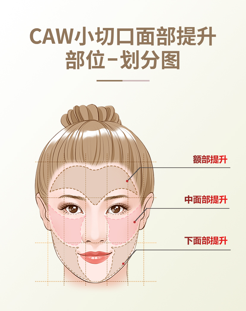 胖嘟嘟的大脸松弛下垂能做拉皮手术吗？