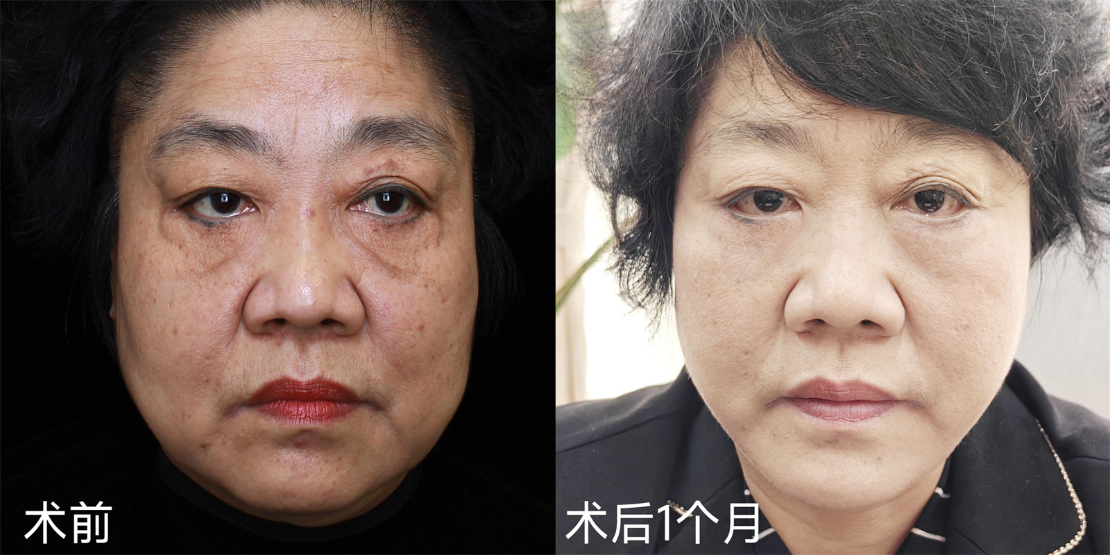 胖嘟嘟的大脸松弛下垂能做拉皮手术吗？