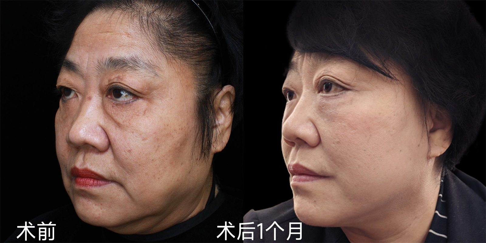 胖嘟嘟的大脸松弛下垂能做拉皮手术吗？