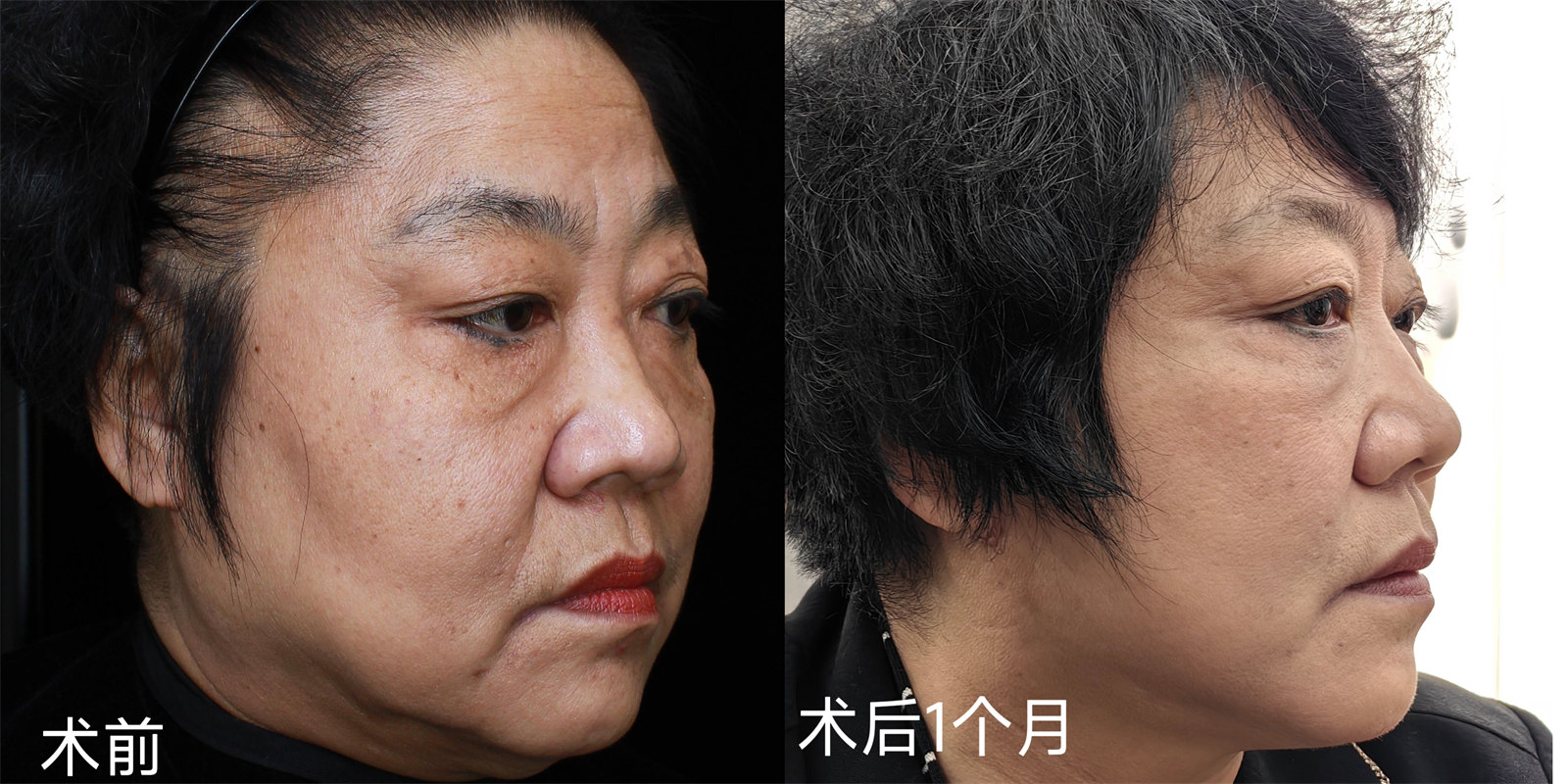 胖嘟嘟的大脸松弛下垂能做拉皮手术吗？