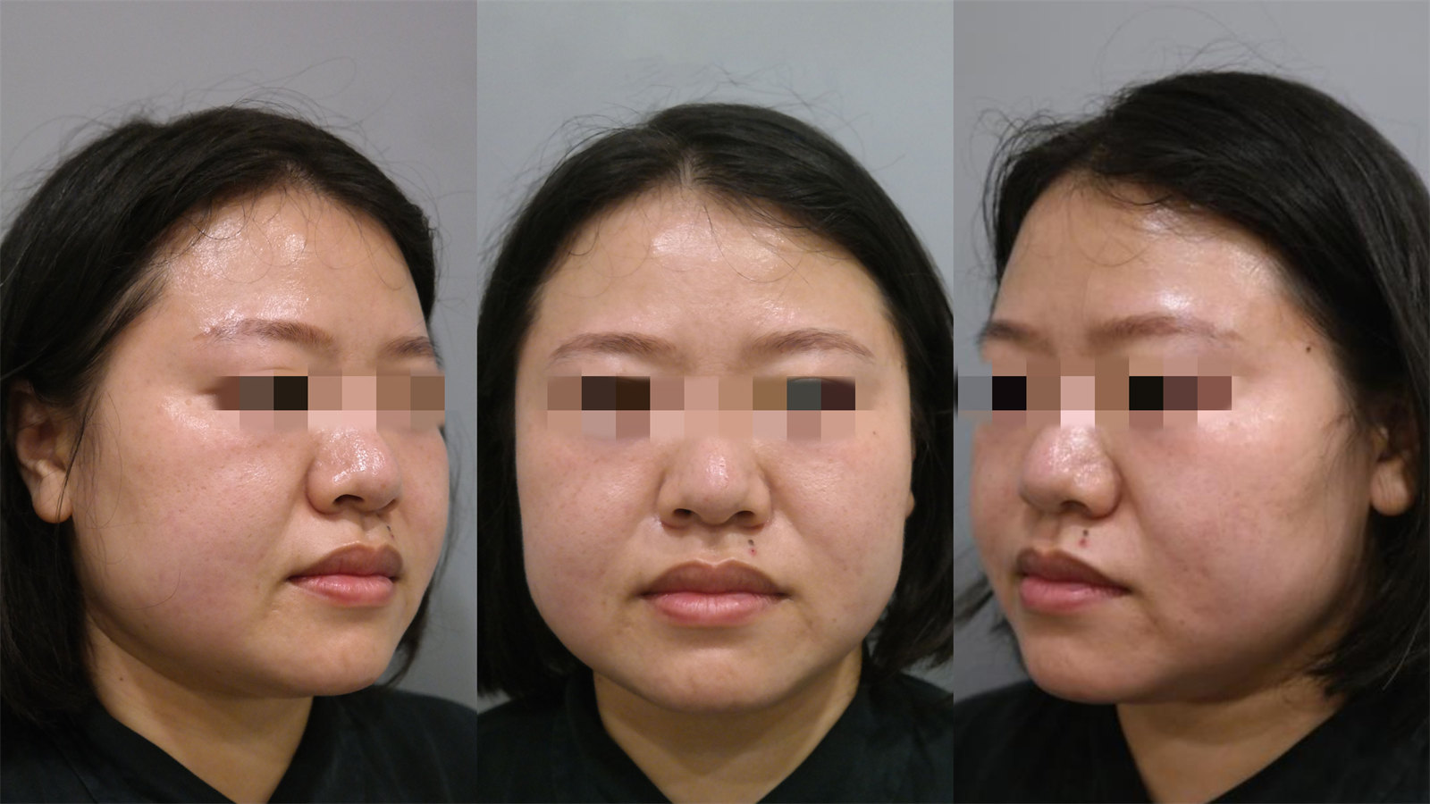 胖嘟嘟的大脸松弛下垂能做拉皮手术吗？