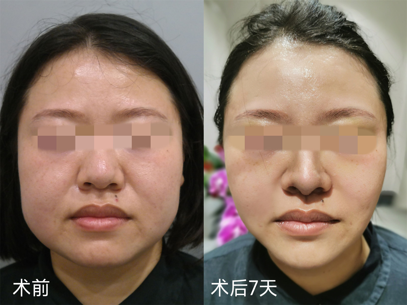 胖嘟嘟的大脸松弛下垂能做拉皮手术吗？