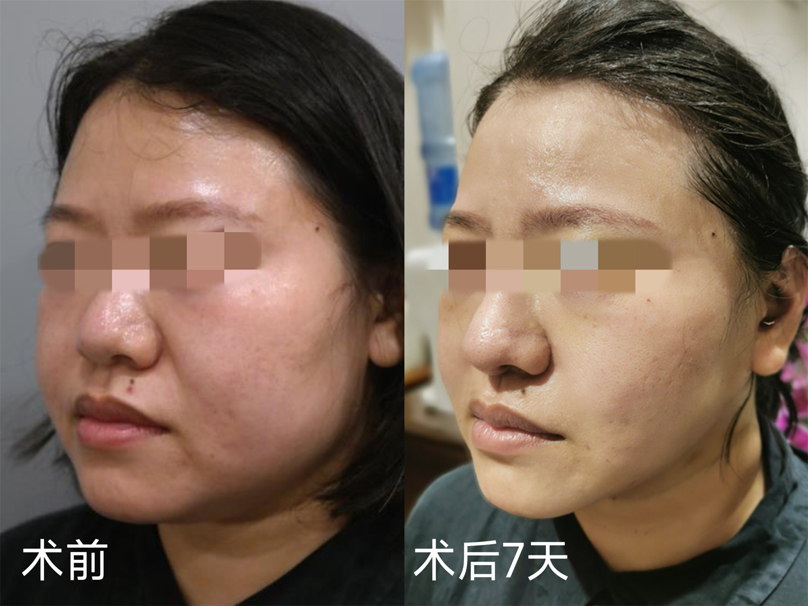 胖嘟嘟的大脸松弛下垂能做拉皮手术吗？