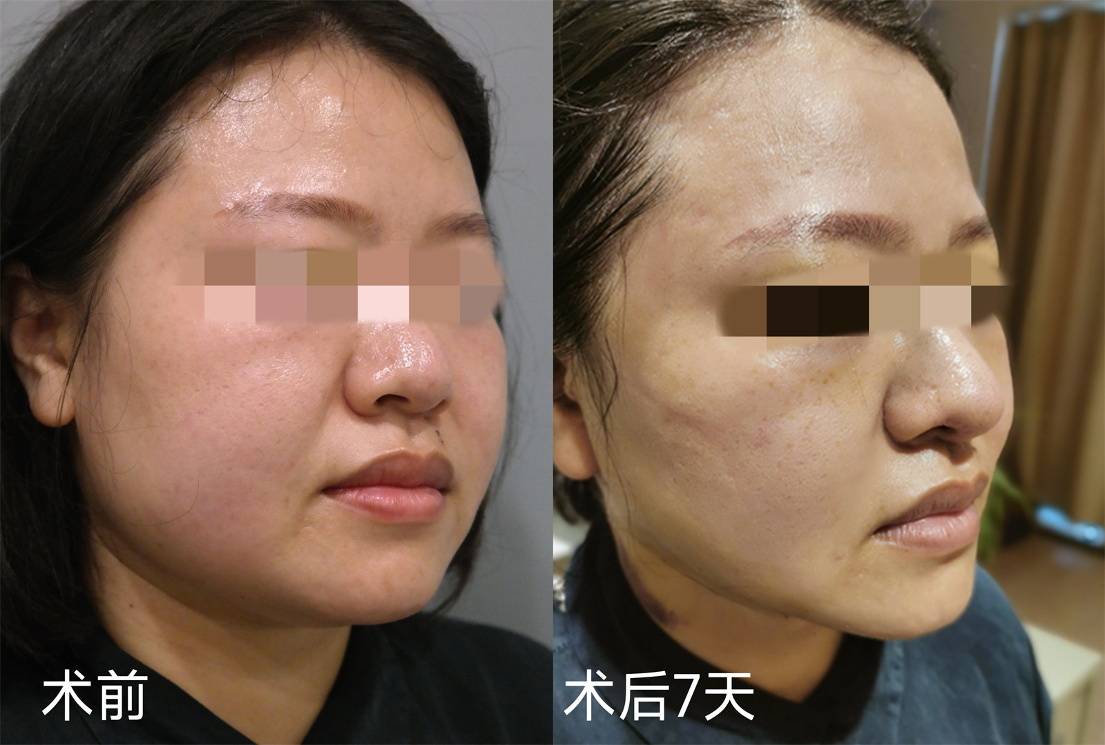 胖嘟嘟的大脸松弛下垂能做拉皮手术吗？