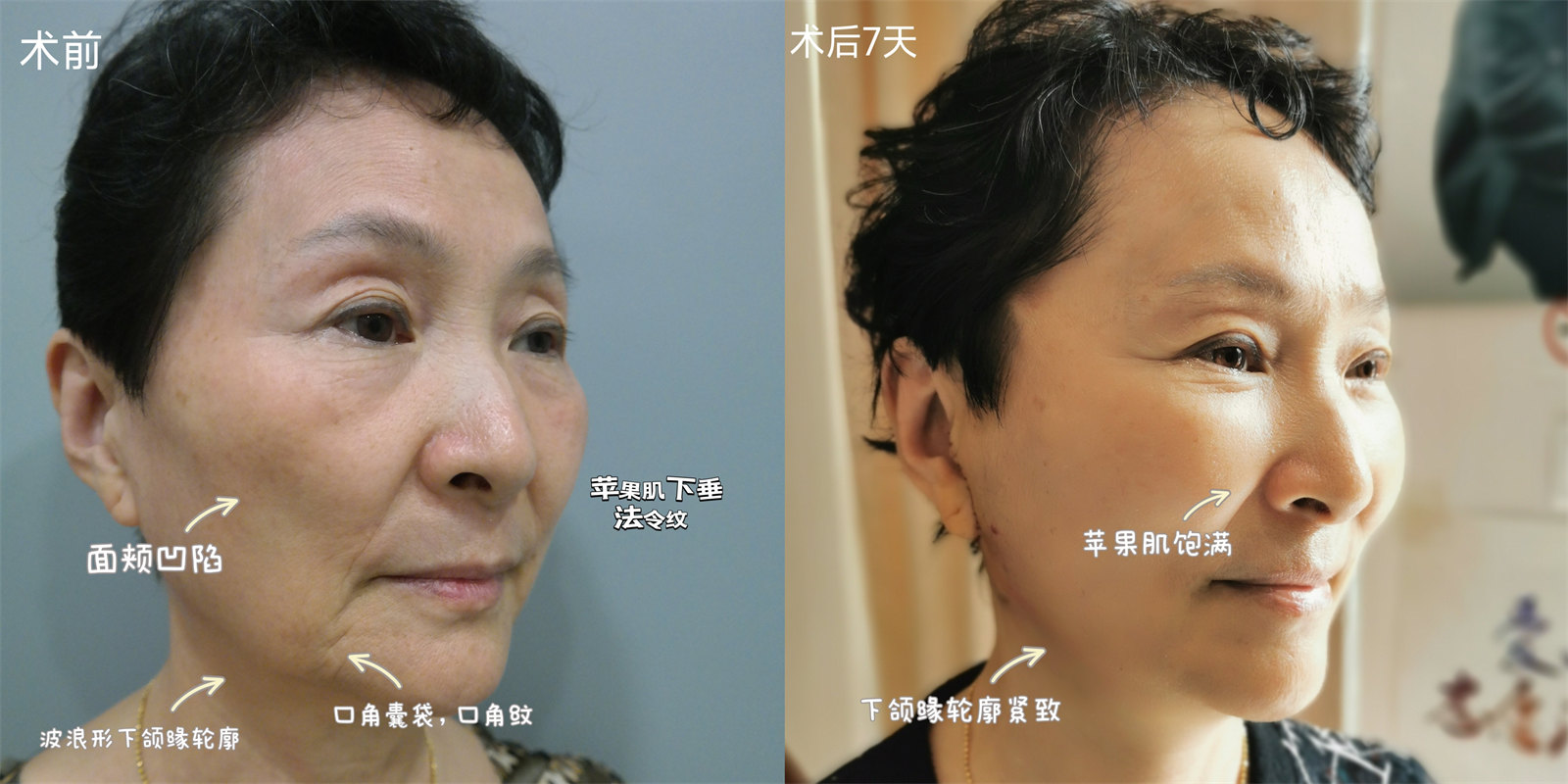 68岁做了拉皮手术，开始逆生长，没想到效果这么好！