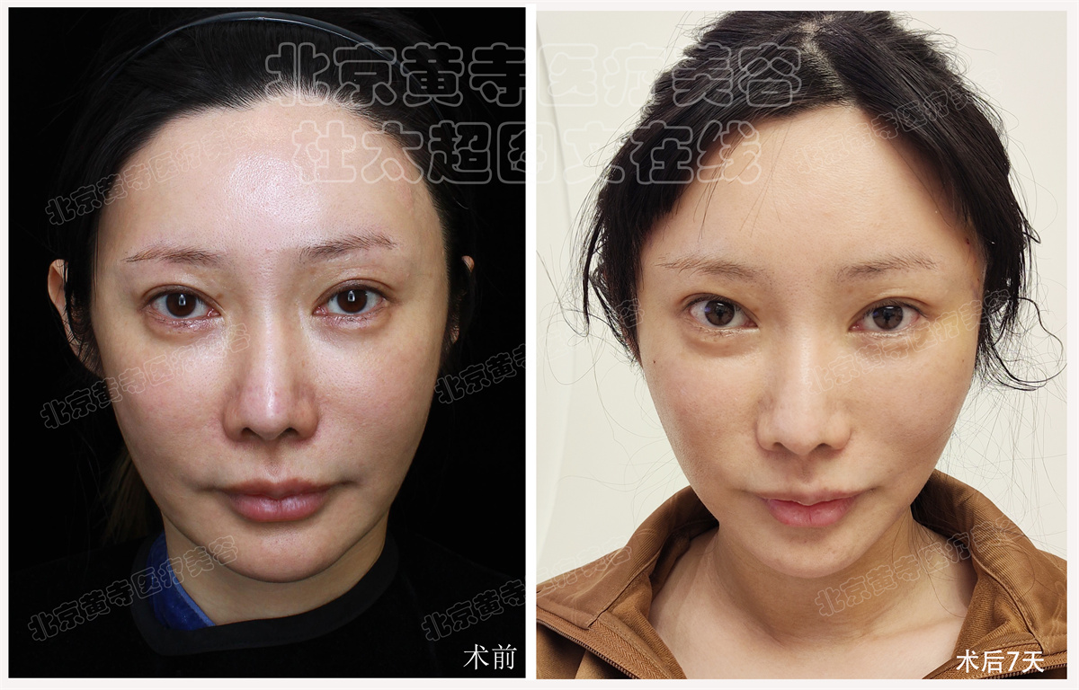 拉皮面部提升术后随访7天