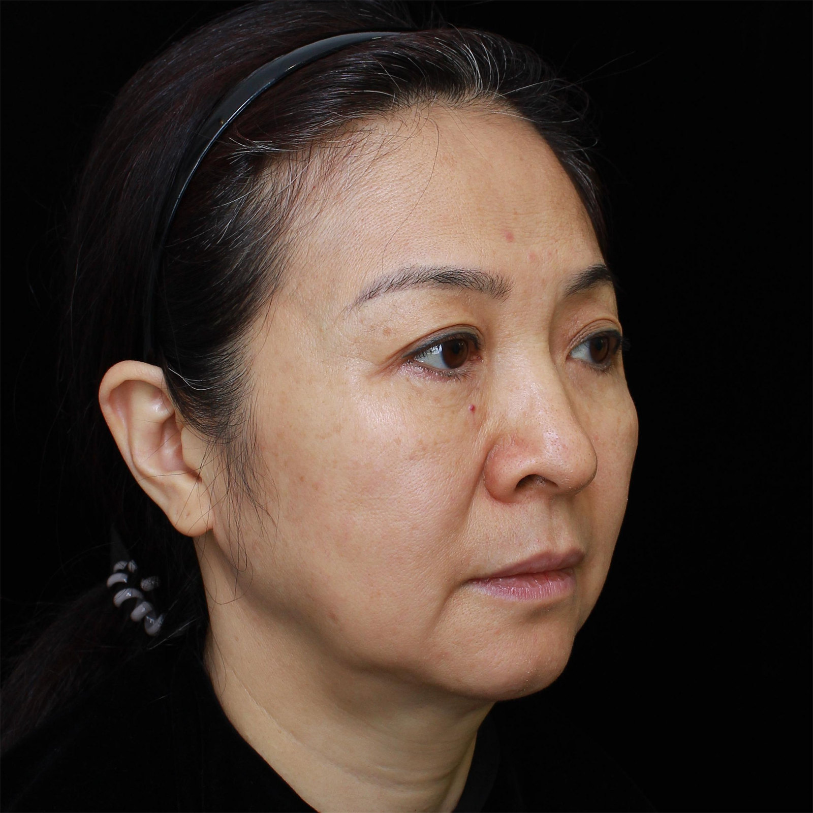 拉皮术后7天，惊喜之余说说心里话！