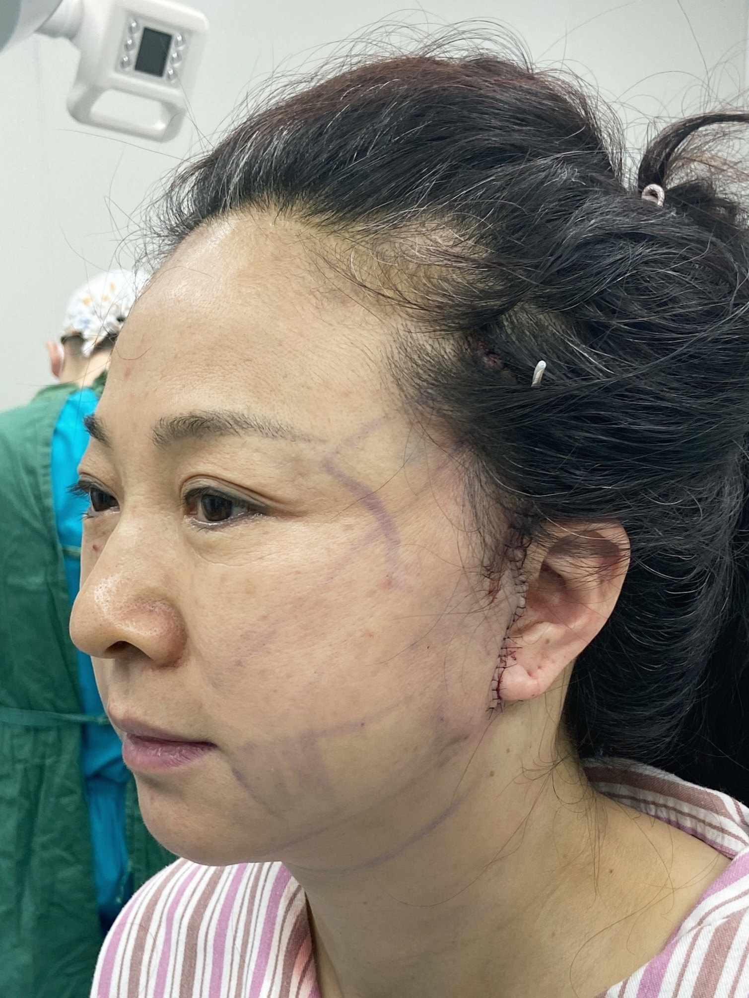 拉皮术后7天，惊喜之余说说心里话！