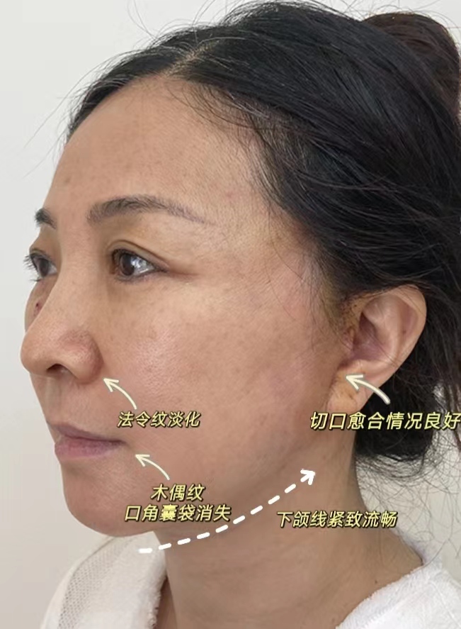 拉皮术后7天，惊喜之余说说心里话！