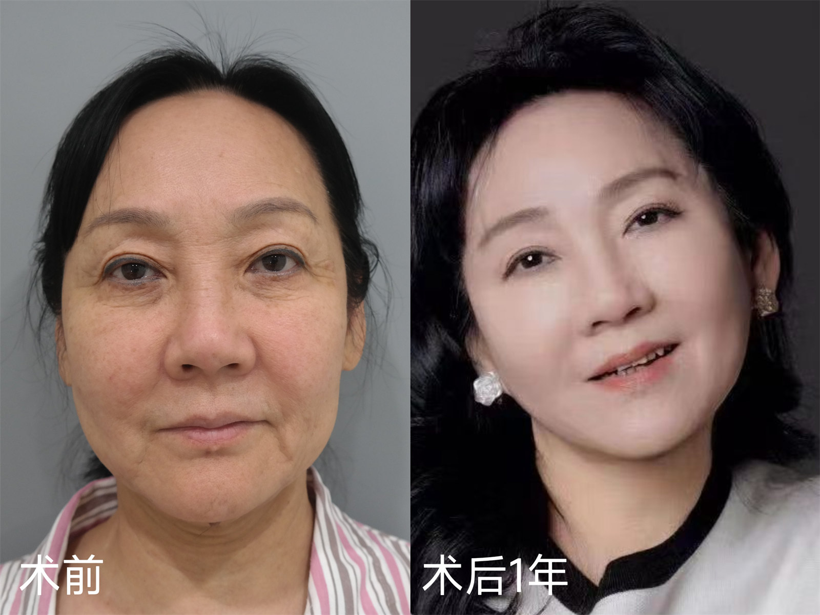 拉皮手术好贵，3个案例告诉你：贵有贵的道理！