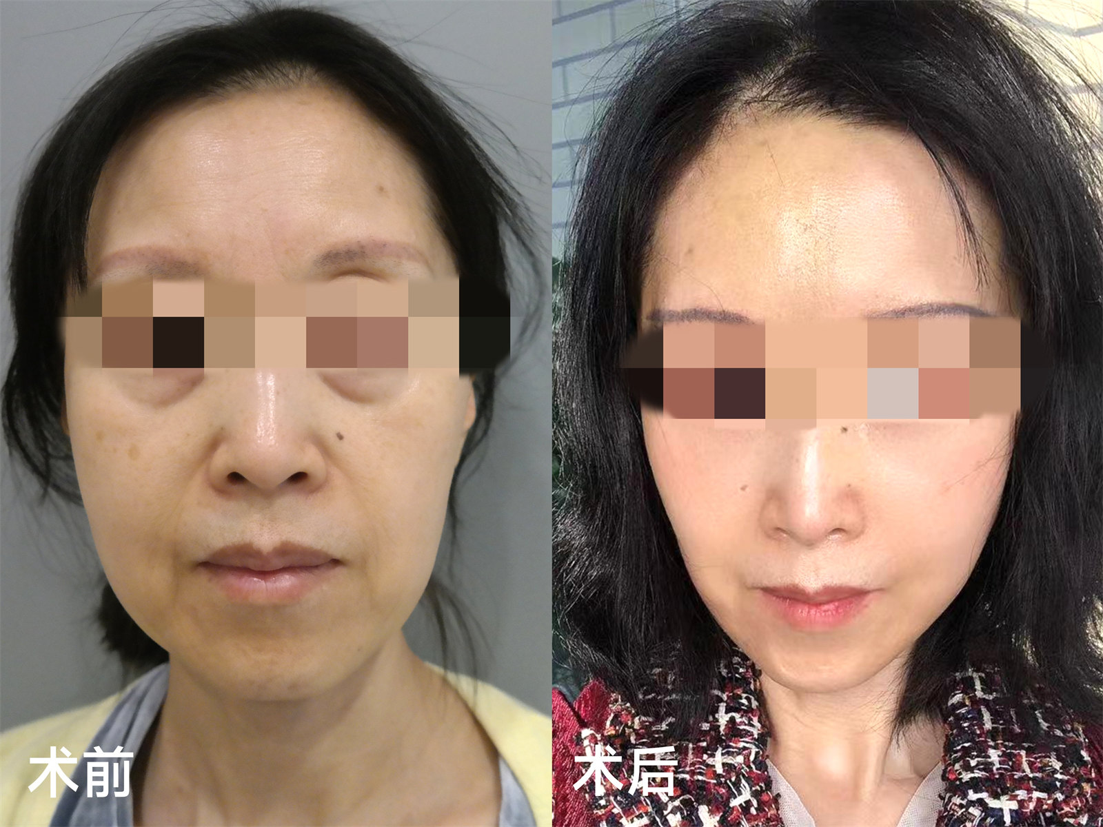 拉皮手术好贵，3个案例告诉你：贵有贵的道理！