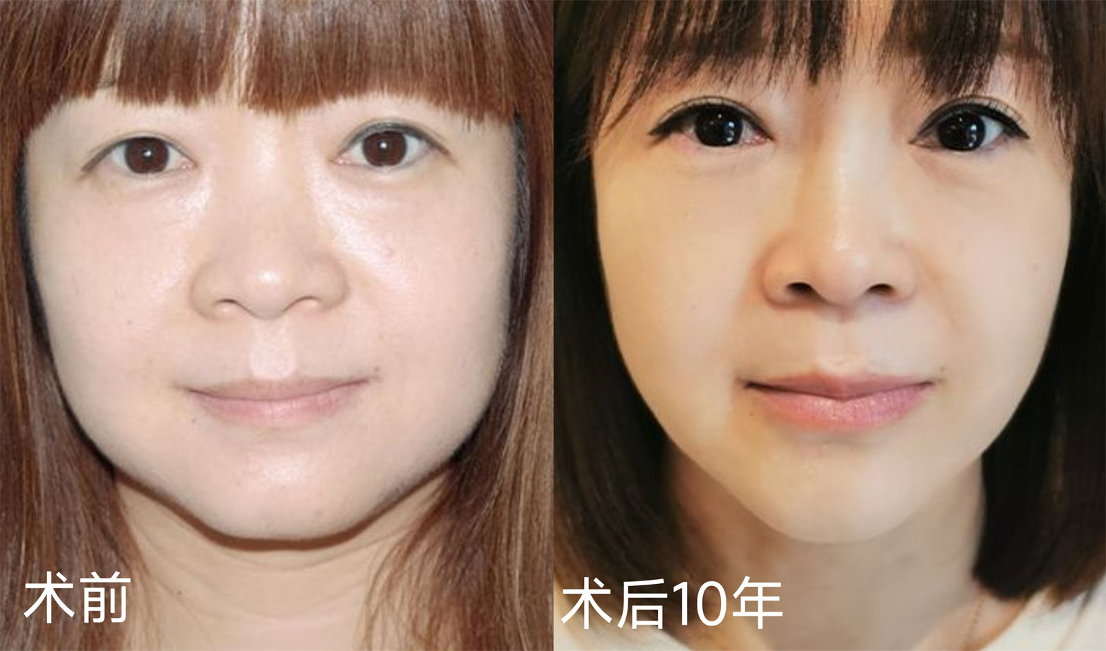 拉皮手术好贵，3个案例告诉你：贵有贵的道理！