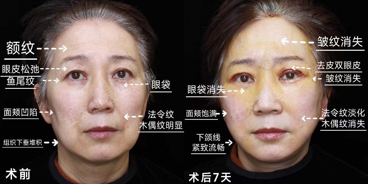 别害怕！带你深度了解拉皮手术前后注意事项