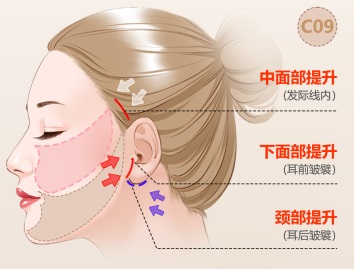 不用填充也能改善法令纹？真人案例现身说法