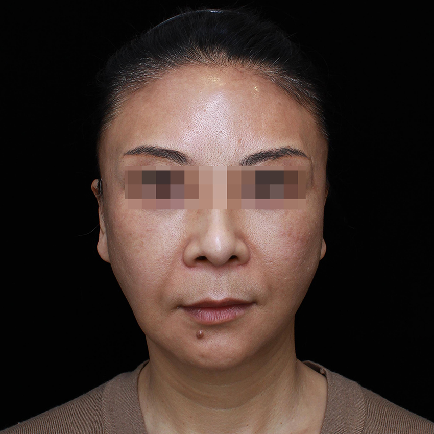 不用填充也能改善法令纹？真人案例现身说法