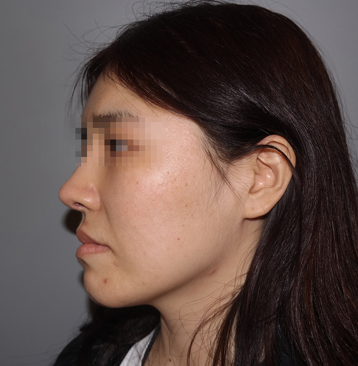 不用填充也能改善法令纹？真人案例现身说法