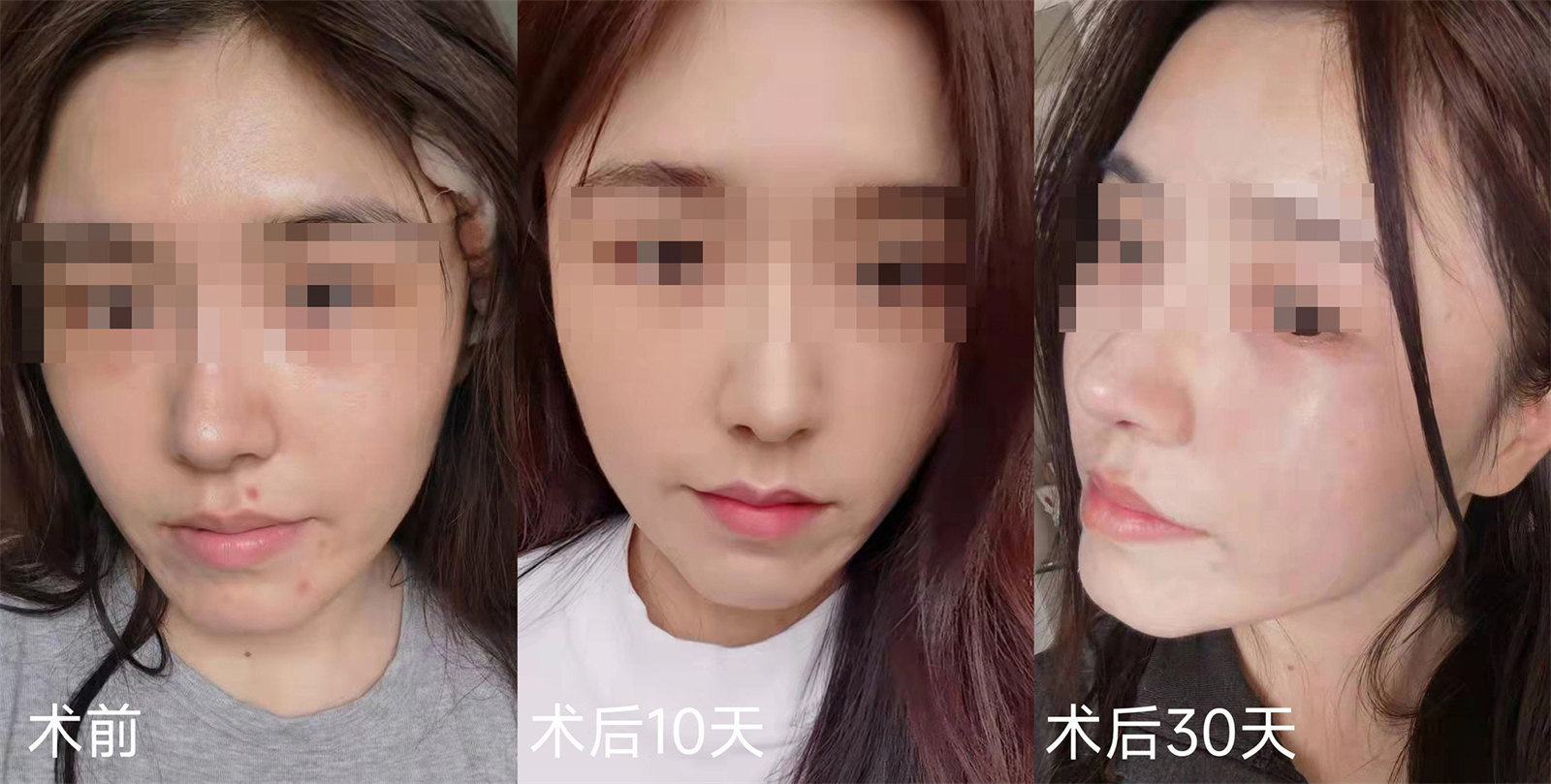 不用填充也能改善法令纹？真人案例现身说法